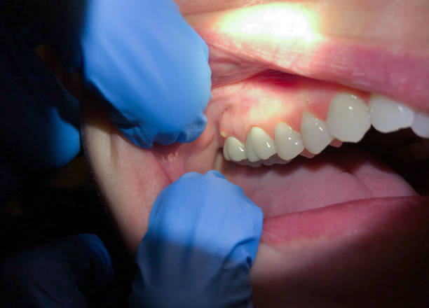 Best Root Canal Emergency Dentist  in Ladonia, AL